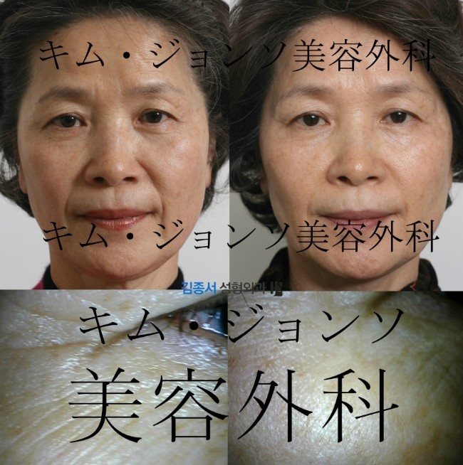 [물광주사] 물광주사 잘하는 곳 / 김종서 성형외과 / 주름리프팅효과 관련 이미지 1