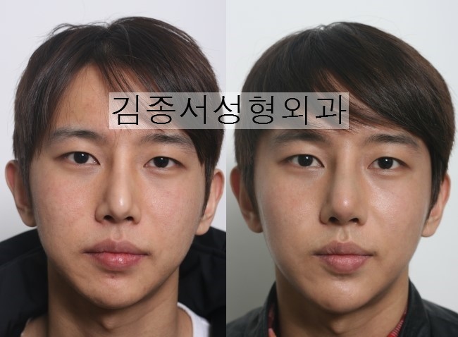 코성형, 찾으셨나요? 관련 이미지 7