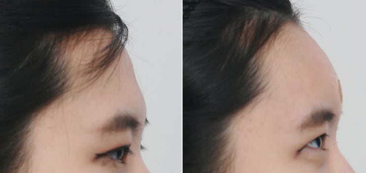 신사동필러 필러로 이마주름 없애기 관련 이미지 1