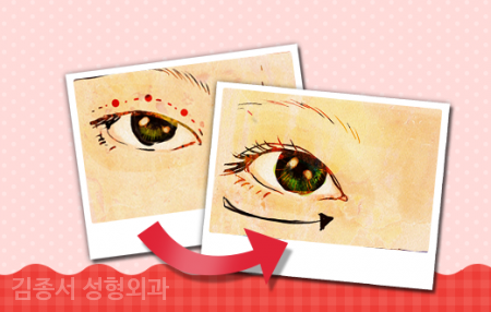 Eye Surgery That Helps to Know image 6