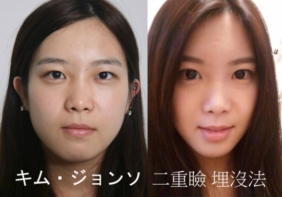 ^^수능생을 위한 합리적인 가격과 적합한 수술방법/스피드 매몰법/앞트임/뒷트임/수능생특가 관련 이미지 1