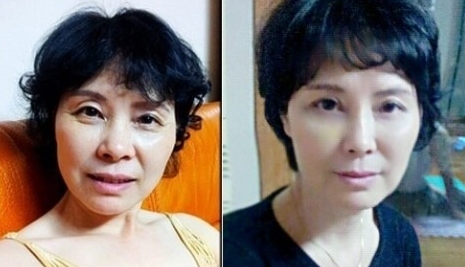 Lower Blepharoplasty at a Gangnam Plastic Surgery Clinic image 1
