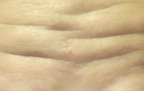 Forehead Wrinkle Removal - Restylane Forehead Filler, Han Go-eun Model Selection image 2