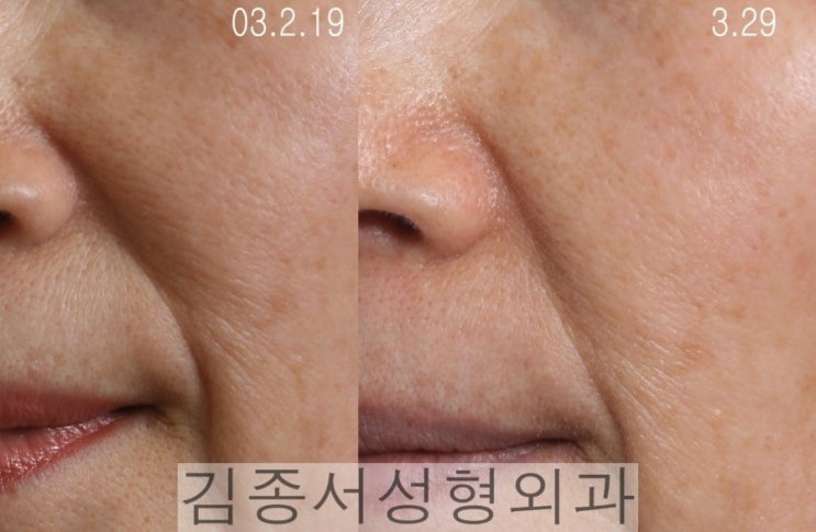홍콩 레스틸렌 비탈 물광주사 개발 강의 후 한국 레티나지 소개 관련 이미지 14