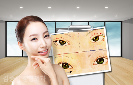 눈성형, 상식 대 방출! 관련 이미지 4
