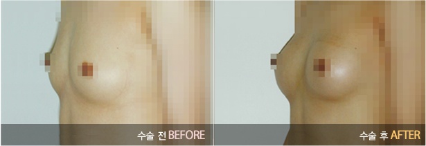 여자의 자존신 물방울가슴 성형! 관련 이미지 7