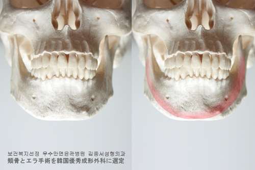 각진 사각턱, 안면윤곽 양악수술로 V라인 얼굴이 되어보자! 관련 이미지 3