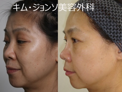 명품필러 레스틸렌 ! 관련 이미지 8