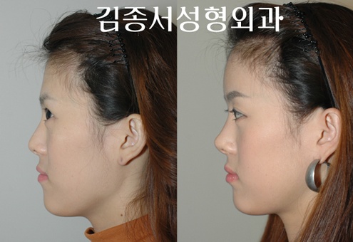 안면윤곽최우수병원- 김종서성형외과의 실리콘 이마성형술 관련 이미지 2