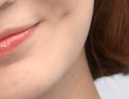 Dimple Surgery at a Plastic Surgery Clinic in Sinsa-dong image 4