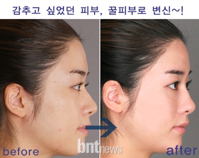 간단한 필러주사로 성형느낌을! 필러성형! 관련 이미지 4