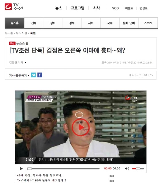 김정은 이마흉터 발견 / 김종서 성형외과 전문의 인터뷰/ 2014년 7월 2일 TV 조선 관련 이미지 1