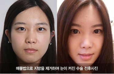 또렷한 눈을 위한 눈성형 - 김종서성형외과 관련 이미지 5