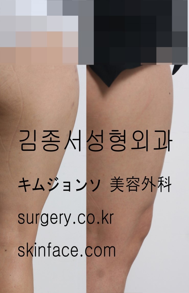 바디톡신 이란? 바디톡신을 알아보자~/ 순수톡신 제오민 / 강력한톡신 디스포트 /김종서성형외과 / 종아리보톡스/ 장딴지보복스/ 승모금보톡스 관련 이미지 3