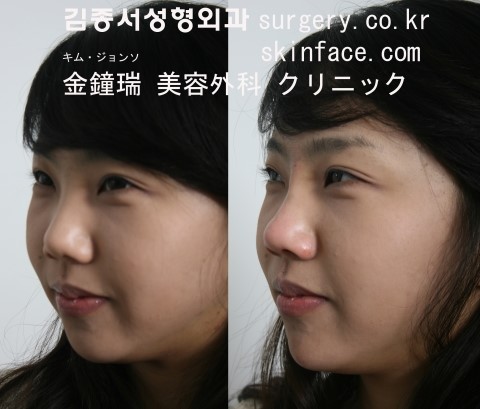 간단한 필러주사로 성형느낌을! 필러성형! 관련 이미지 8