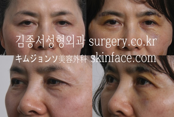 눈꺼풀이 늘어졌는데 쌍꺼풀 하기는 싫다면 ? 눈썹절개 리프팅 100만원 / 김종서성형외과 관련 이미지 1