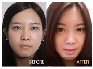 Sinsa-dong Eye Surgery - Speed Buried Suture Method / Double Eyelid Surgery image 2