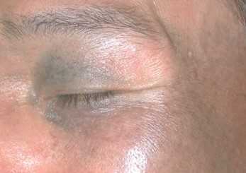 Sinsa-dong Plastic Surgery Clinic - Ota Nevus Treatment image 2