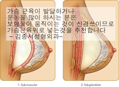 물방울 보형물 / 김종서성형외과 관련 이미지 7