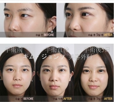 Blepharoplasty Is Easier Than You Think image 6