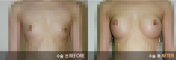 여자의 자존신 물방울가슴 성형! 관련 이미지 8