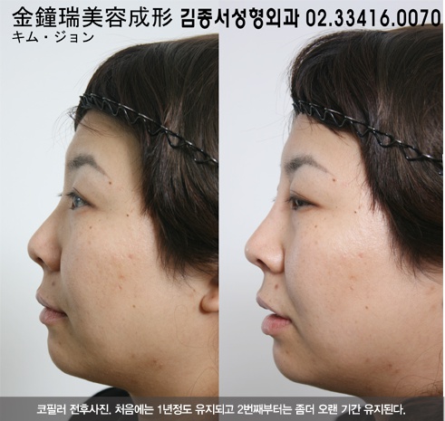 내 얼굴에 가장 잘 어울리는 필러성형은?~~~(restylane,레스틸렌,엘란쎄,Ellanse,Radiesse,래디어스,이마필러,이마성형) 관련 이미지 5