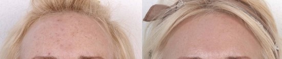 여드름흉터, 모공관리에 효과적인 프락셀레이저 관련 이미지 1