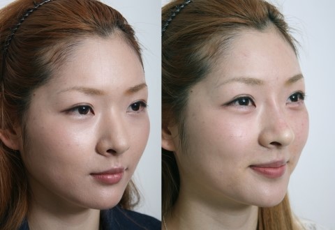 동안얼굴지름길 필러성형 관련 이미지 6