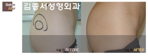 s라인 힙업수술 !! 관련 이미지 8