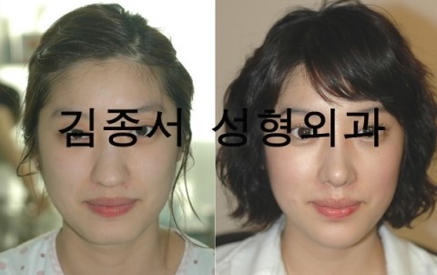 [압구정콧볼축소술] 달라진 콧볼축소술전후~ 김종서성형외과 관련 이미지 2