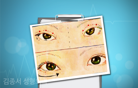 Shattering Myths About Eye Plastic Surgery! image 5