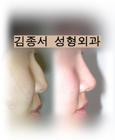 [김종서성형외과] 무통, 무부담 미리보고 하는 3차원 가상공동성형~ 관련 이미지 3
