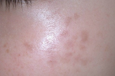 Sinsa-dong Plastic Surgery Clinic - Ota Nevus Treatment image 1