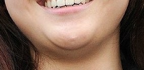 턱밑살제거주사 - 얼굴라인 주사 관련 이미지 3