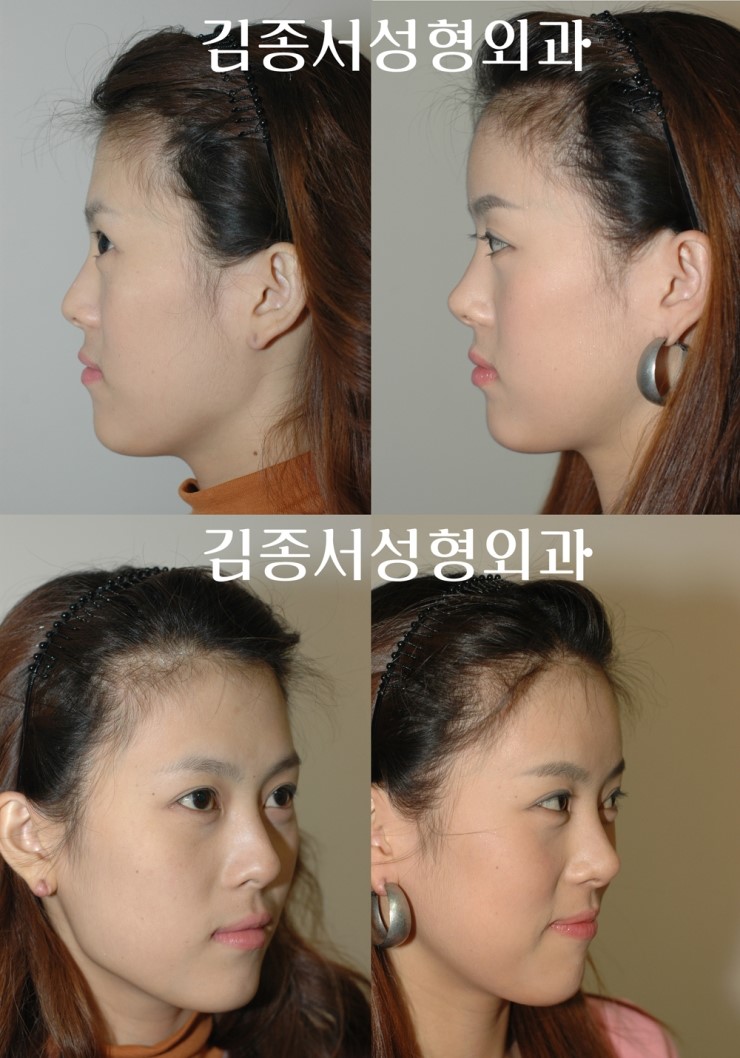 이마 성형 2002년부터 연구발표, 수많은 신문 기사에 ..김종서성형외과/ 봉긋한 이마 /동안이마 관련 이미지 3