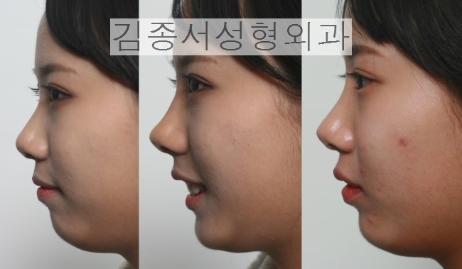 Concise and Clear, Nose Surgery Information! image 6