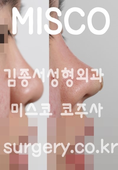 미스코 시술 직후 사진  김종서성형외과 / 모델 미스코 전후사진공개 관련 이미지 2