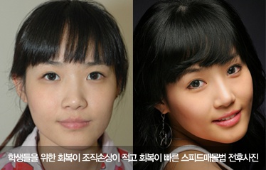 또렷한 눈을 위한 눈성형 - 김종서성형외과 관련 이미지 6