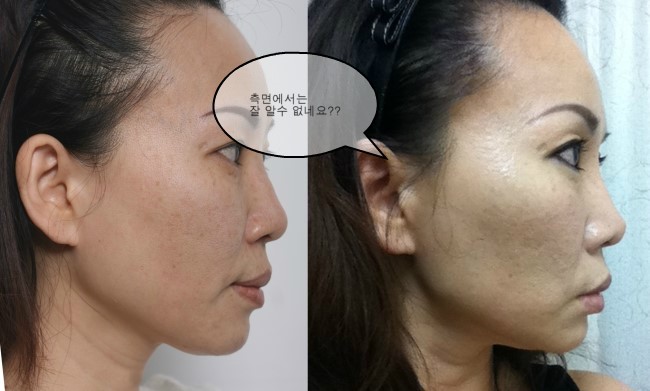 V-loc 리프팅과 사각턱 보톡스로 갸름해진 얼굴 사진 / 김종서성형외과/ 리프팅, 실루엣, 브이락, 성형, 주름, 실리프팅 관련 이미지 2
