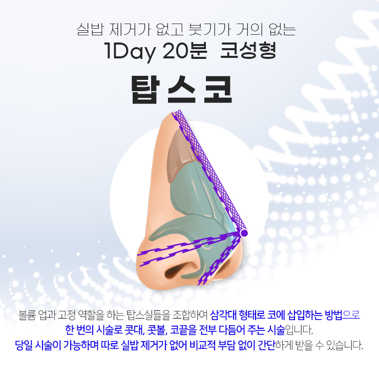 탑스코 ~간단한 시술로 콧대&middot;콧등&middot;콧대까지 한 번에!~ 관련 이미지 5