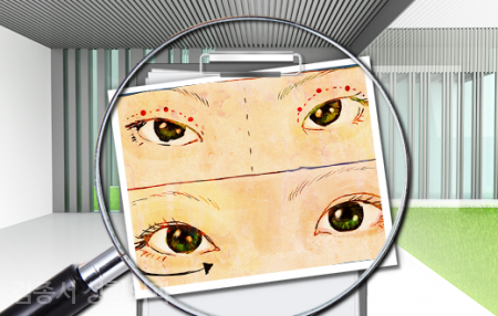 Eye Surgery That Helps to Know image 4