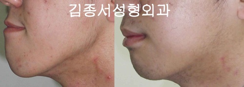압구정안면윤곽전문 - 김종서성형외과의 돌출입성형&주걱턱성형 관련 이미지 7