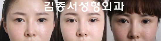 매몰법으로 눈을 더 크게하고 뒤트임을 해서 시원한 아웃폴드로 만든 사진/ 수술 이모저모 관련 이미지 1