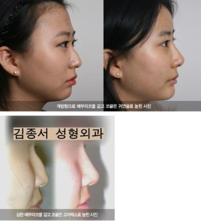 생생정보통 코성형 관련 이미지 2