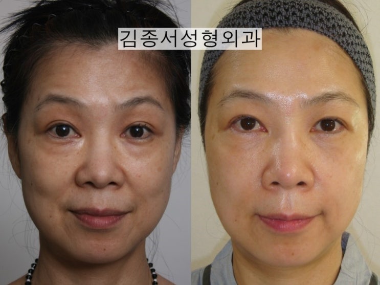 홍콩 레스틸렌 비탈 물광주사 개발 강의 후 한국 레티나지 소개 관련 이미지 12