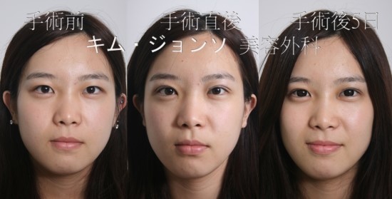 ^^수능생을 위한 합리적인 가격과 적합한 수술방법/스피드 매몰법/앞트임/뒷트임/수능생특가 관련 이미지 2