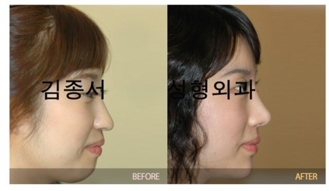 푱푱! 날아오는 코성형 정보 관련 이미지 3