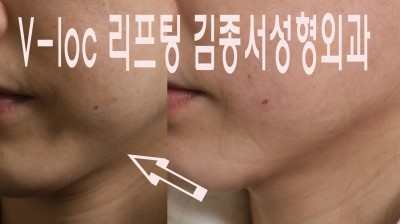 V-loc 180 리프팅 / 비절개 V-loc 시술 2013 대한성형외과학회 발표 김종서성형외과 (브이락리프팅,실루엣,성형,주름,실리프팅) 관련 이미지 2