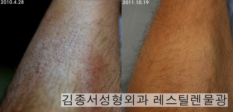 홍콩 세미나/ 레스틸렌 물광 / 김종서성형외과원장 2014-6-10-화 관련 이미지 2