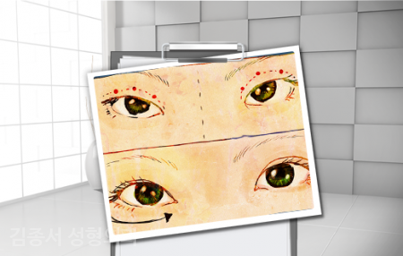 Detailed Eye Plastic Surgery Information! image 4